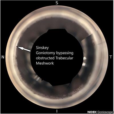 Early cataract surgery and affordable Sinskey hook goniotomy in Black and Afro-Latino glaucoma patients: a 6-month retrospective study